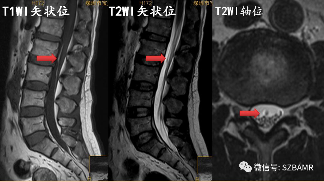 椎管内硬膜外脂肪增多症与终丝脂肪沉积