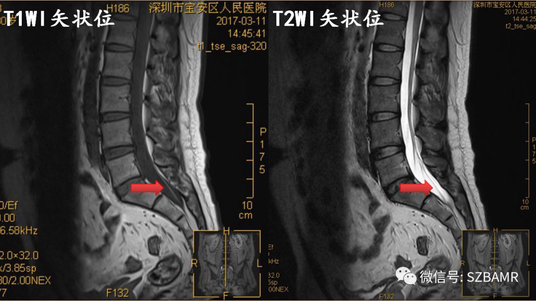 腰椎终丝图片