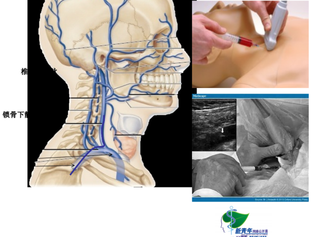 中心静脉穿刺解剖图图片