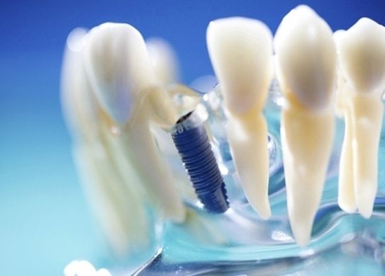 相对于一般种植牙技术,正夫双波长激光种植牙更快速,舒适,不会对口腔