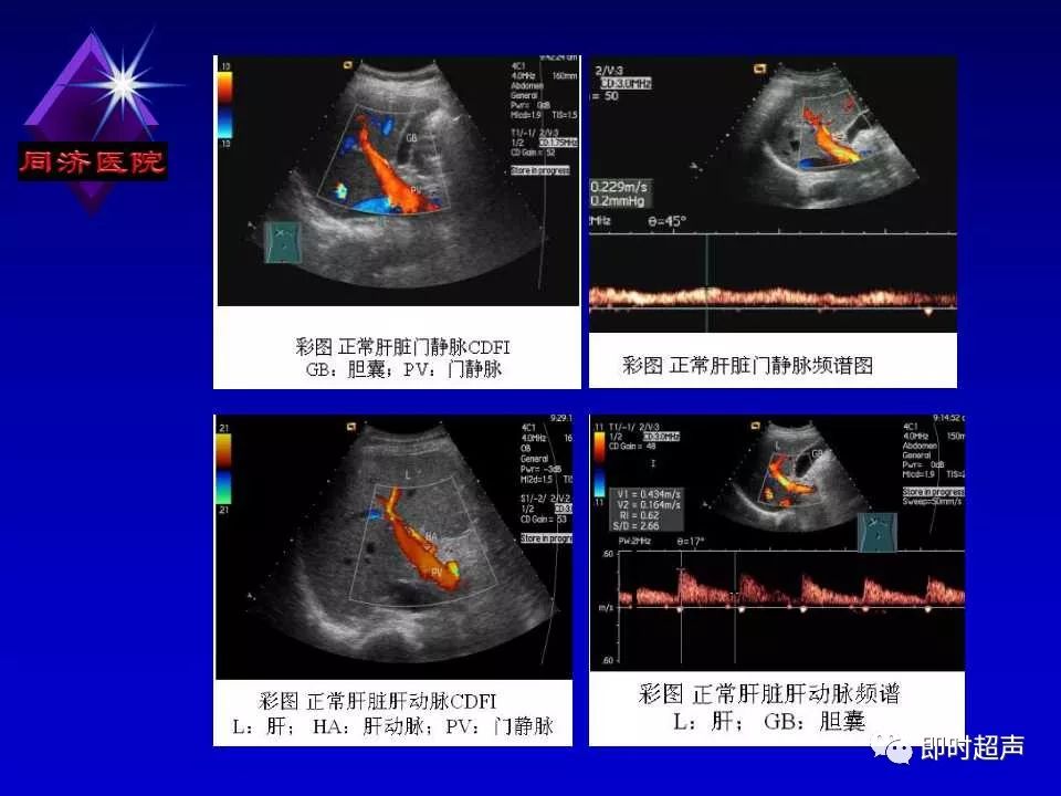 超声肝脏工字征图解图片