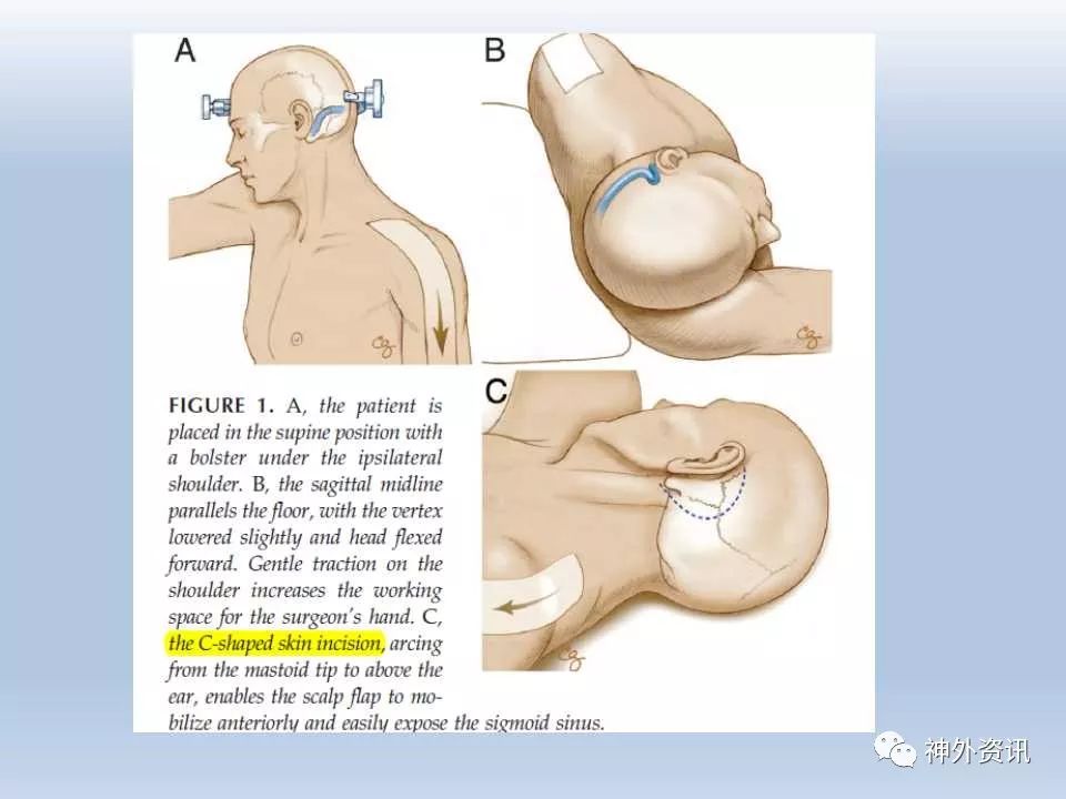 乙状窦后入路切口设计图片