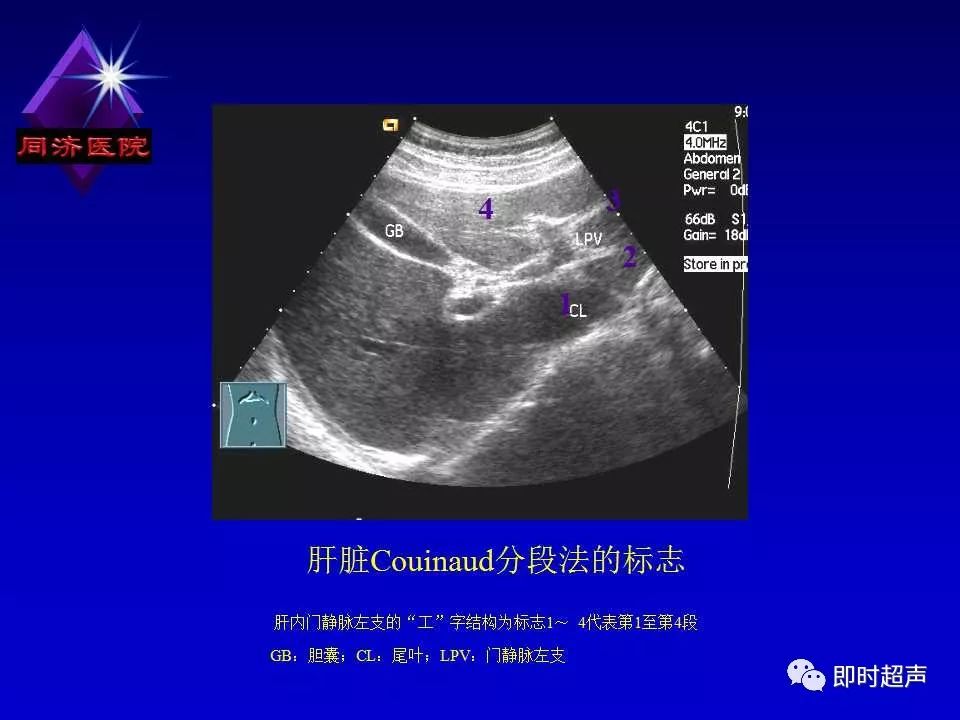 正常肝脏的超声解剖及局限病变的超声诊断