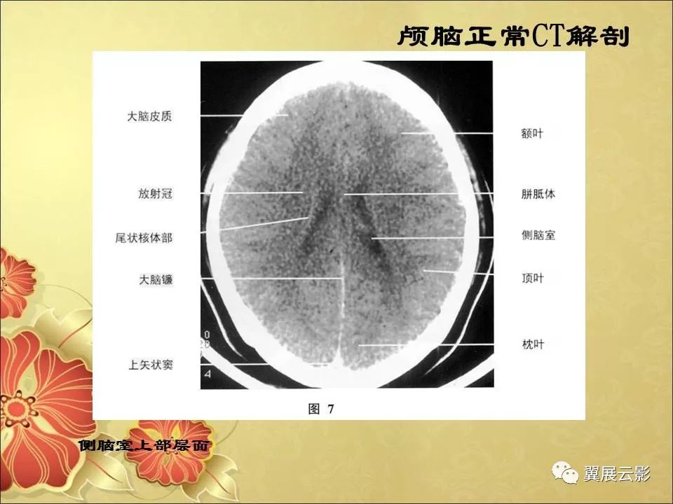 基底节放射冠CT位置图片