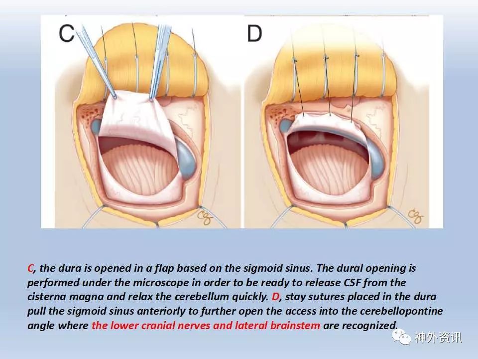 乙状窦后入路切口设计图片