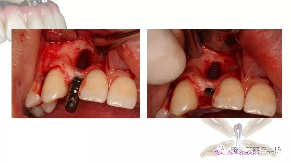 備洞,放置平行杆檢查種植軸向右上2手術,牙槽嵴頂切口加13遠中垂直