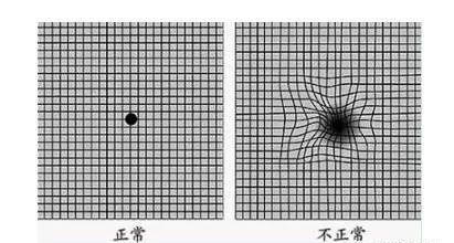 视物变形自测图片