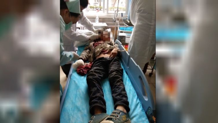 什麼手機又爆炸?廣西12歲男孩手指被完全炸斷,右眼可能失明