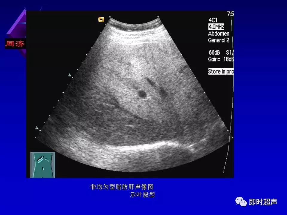 脂肪肝声像图改变图片