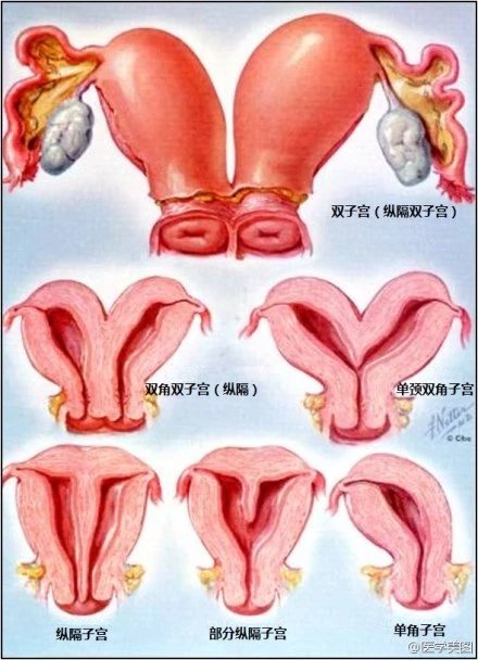 各種常見子宮畸形19.第一產程宮頸擴張程度類比18.處女膜孔的類型17.