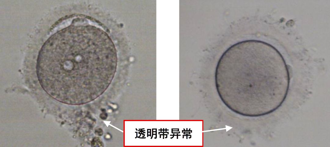 選美冠軍得主研究表明,卵母細胞形態異常可影響正常受精和胚胎髮育