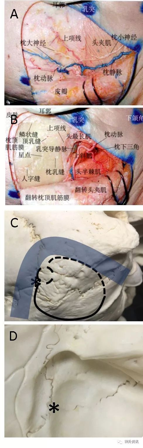 乙状窦后入路切口设计图片