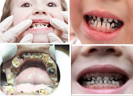 很多家长都觉得,宝宝因为吃奶粉,才会导致牙齿不好.其实并不全是这样!