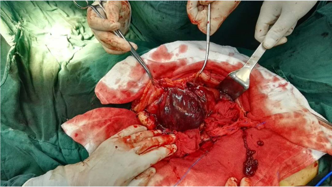 外科四病区成功完成一例巨大腹腔及盆腔继发恶性肿瘤联合脏器切除手术