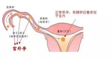 宫外孕导致的腹痛,通常还会伴有阴道出血