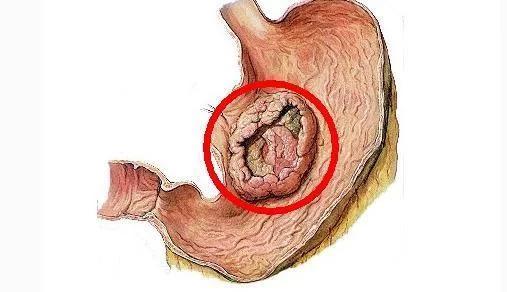 胃癌的五大早期症状，是什么原因导致的 得了胃癌还能活多久？能痊愈吗？