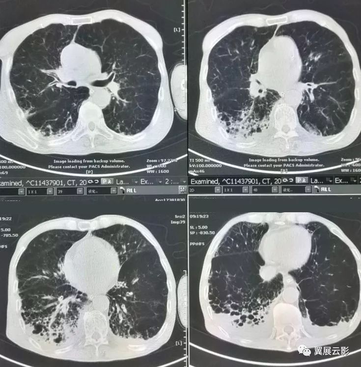 多发肺囊肿,肺结核可以表现为蜂窝状影之外,很有一种肺炎型肺癌应该
