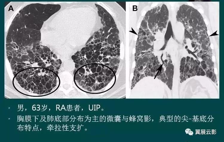 下面看几例典型的蜂窝肺影像:蜂窝肺为多种晚期肺疾病的终末期表现