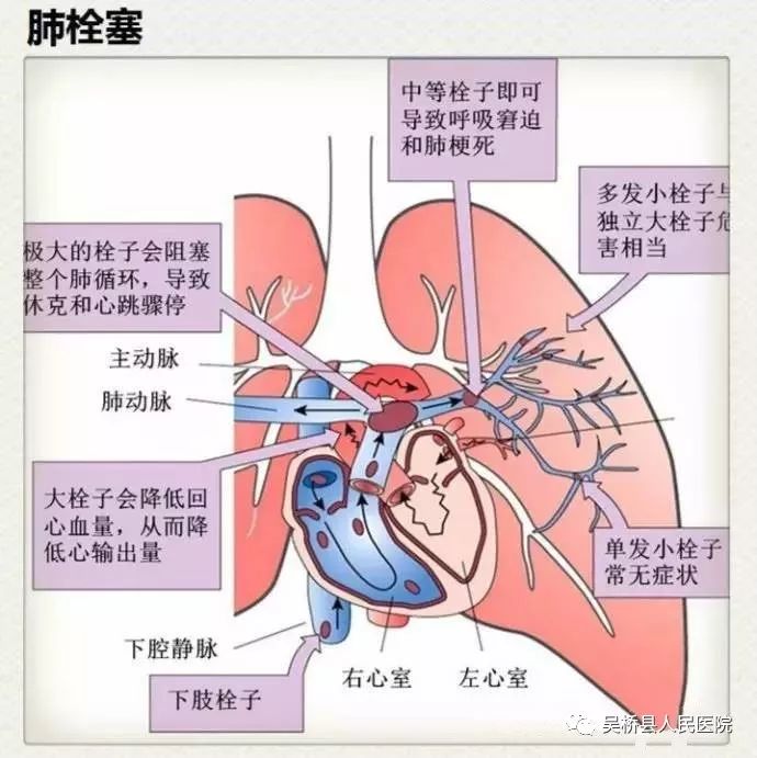 肺栓塞形成机制图片