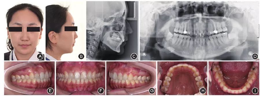 病例分享無託槽隱形矯治技術矯治錯牙合畸形伴深覆牙合一例