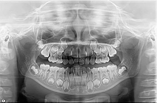 全景x光片:拍摄x光片,查看乳牙牙根以及恒牙胚的发育是否正常