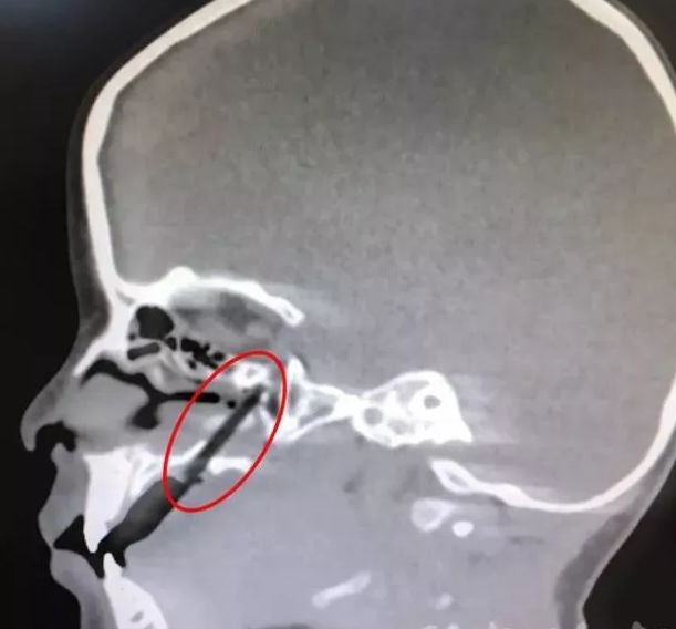 半截筷子插进宝宝上颚快过年了千万别这样给孩子吃