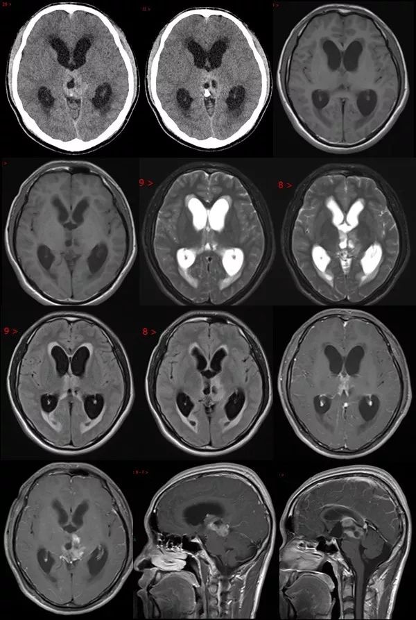 ct示松果體區,三腦室旁見稍高密度影,mri上t1wi呈等及稍低信號,t2wi呈