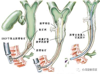 ercp(經內鏡逆行胰膽管造影),是指將內鏡經口插入十二指腸,經十二指腸