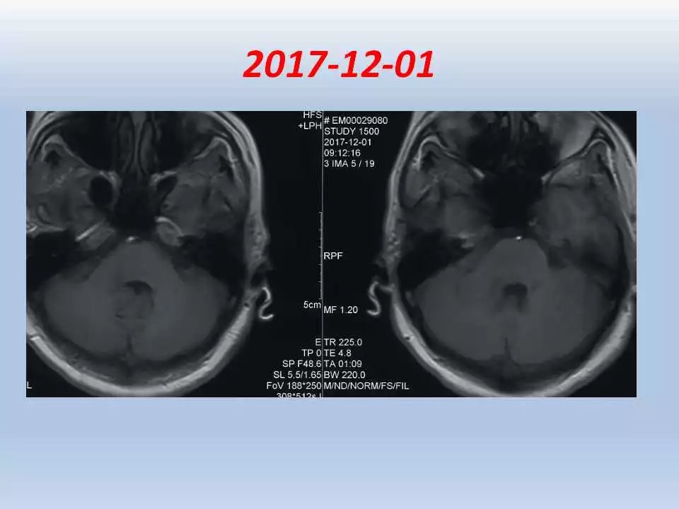 表皮囊肿黑色图片