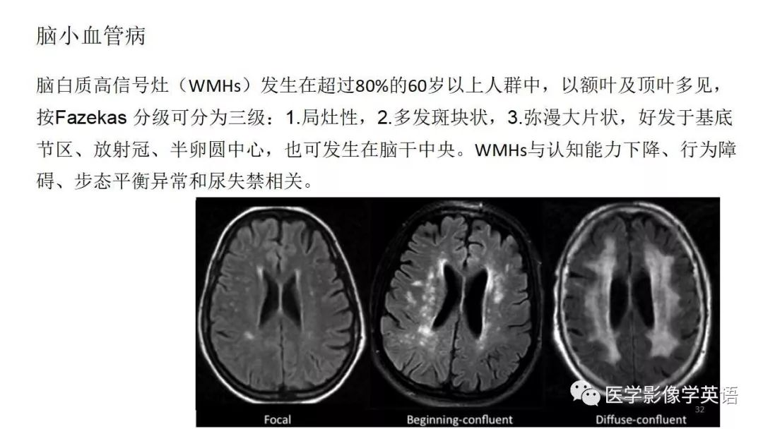 [rg精选] 脑白质病影像与病理对照