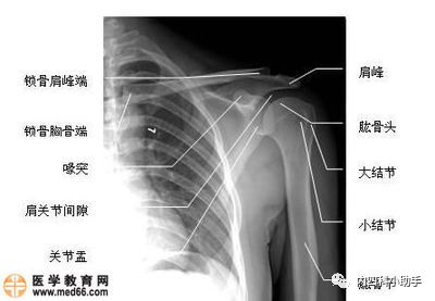 肩关节半脱位诊断标准图片