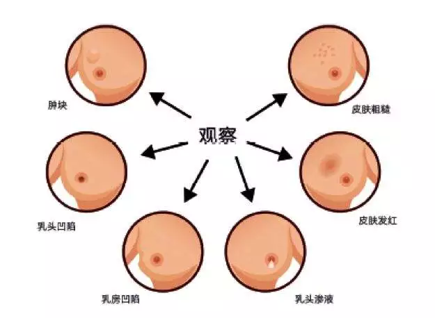 乳腺瘤的症状与图片图片
