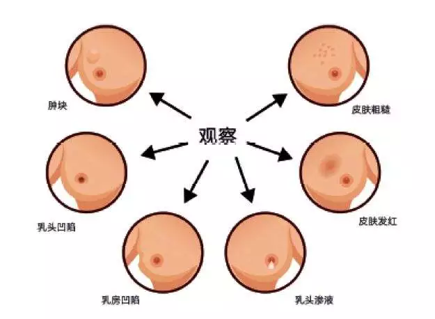 乳腺纤维瘤的位置图片图片