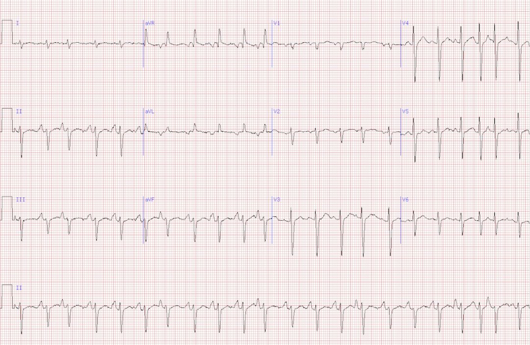 該患者心電圖所示節律為竇性心律,但伴有頻發性房性異位搏動.