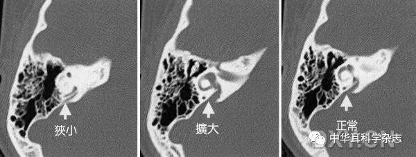 耳蜗导水管图片