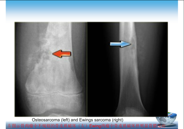 骨肿瘤的影像学鉴别诊断