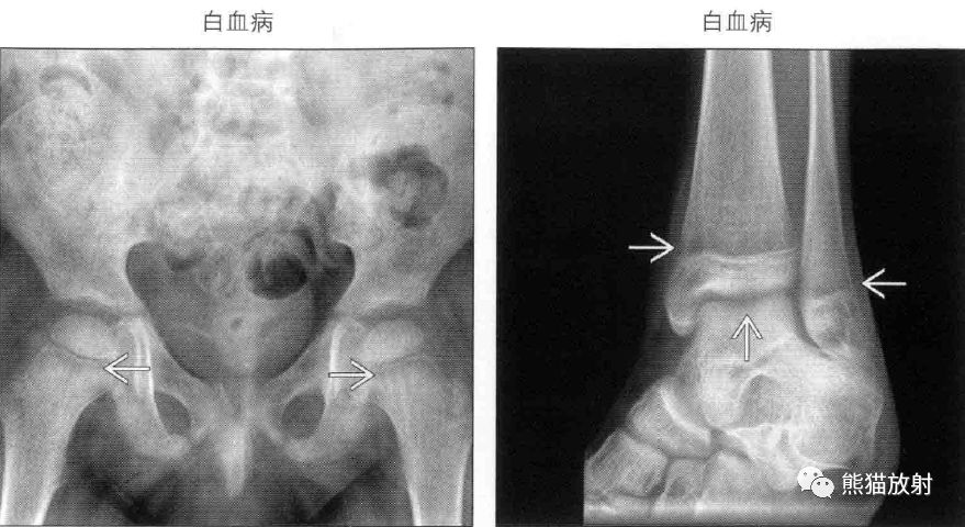 长骨干骺端图片