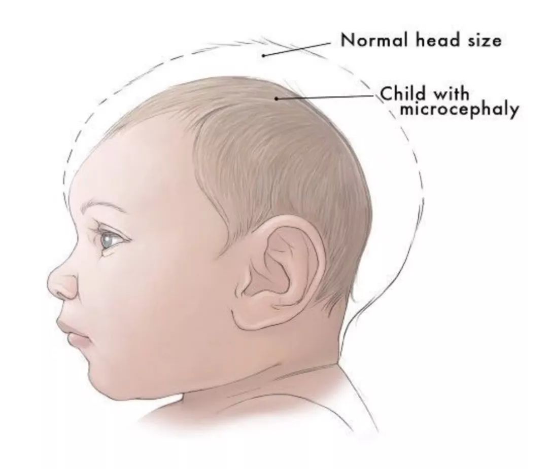 家长必看未现寨卡小头症婴儿也可能存在严重脑损伤