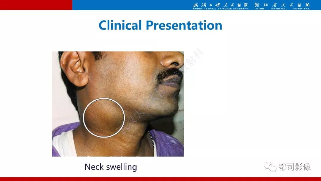 颈部神经鞘瘤影像诊断