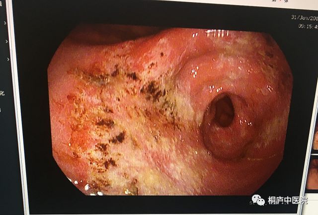 胃黏膜吐出来图片图片