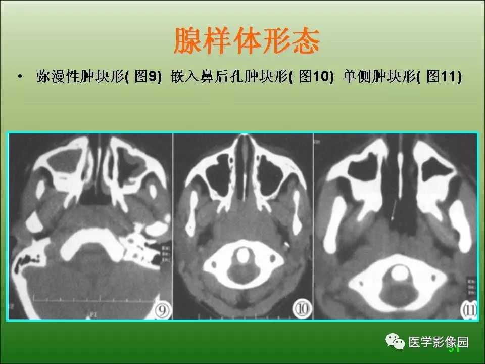 腺样体肥大ct图详解图片