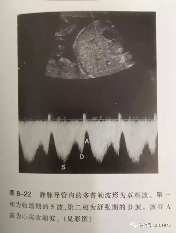 综上所述,静脉导管频谱异常,可作为早孕