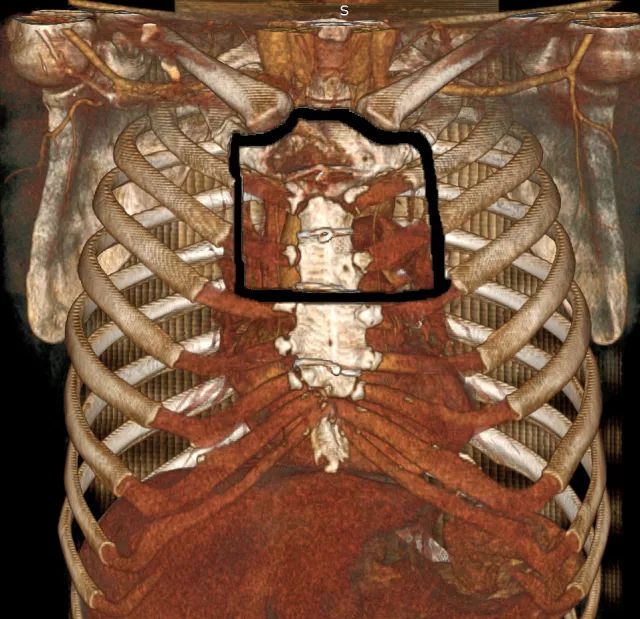 胸骨柄肿瘤图片图片