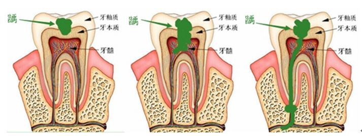 牙骨质牙本质界图片