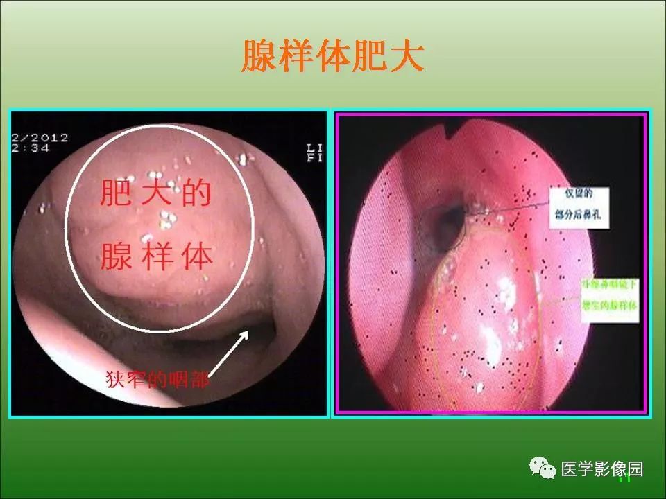 兒童腺樣體肥大影像表現及診斷標準丨影像天地