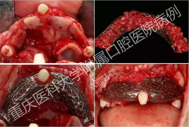 牙槽骨手术失败图片图片