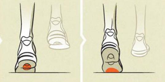 跑者患足內翻有何標誌?緩解症狀應重視跑鞋選擇