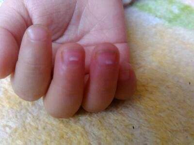 【手指甲上有白点】手指甲上有白点是怎么回事_宝宝手指甲上有白点怎么办