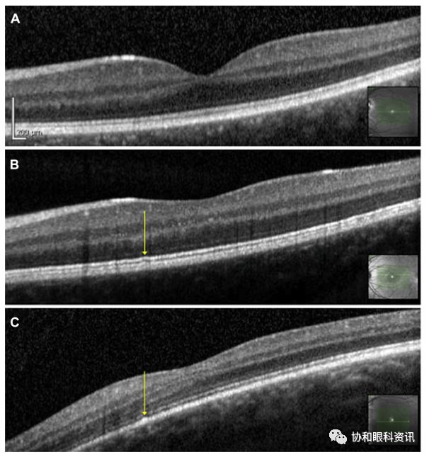 a,正常的oct b,椭圆体带轻微不规则 c,rpe层轻微不规则(本文图表均