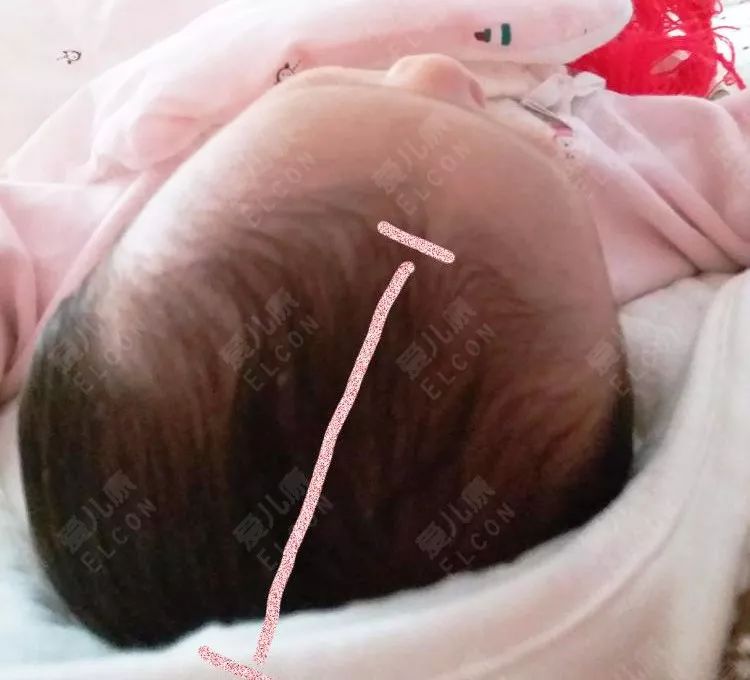 宝宝缺钙的头部照片图片